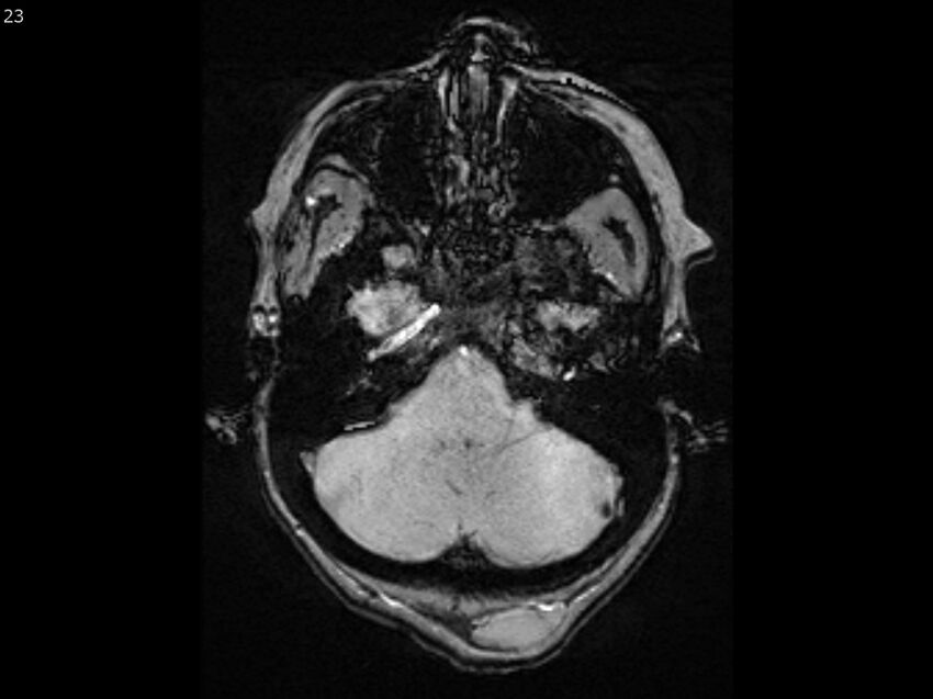 Atypical meningioma - intraosseous (Radiopaedia 64915-74572 Axial SWI 23).jpg