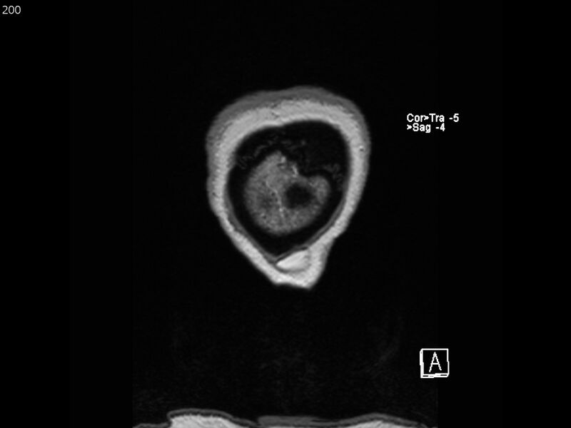 File:Atypical meningioma - intraosseous (Radiopaedia 64915-74572 Coronal T1 200).jpg