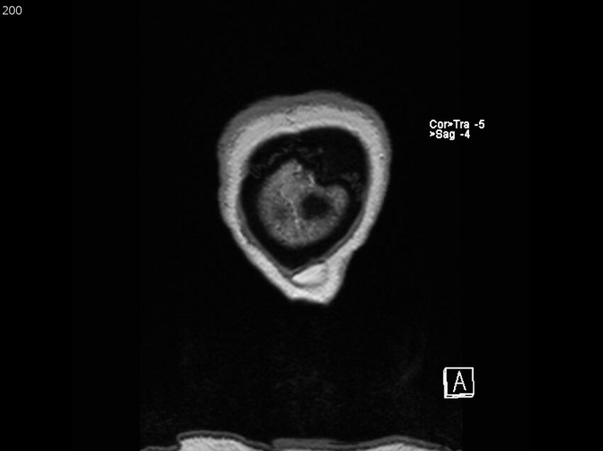 Atypical meningioma - intraosseous (Radiopaedia 64915-74572 Coronal T1 200).jpg