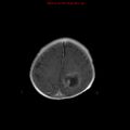 Atypical teratoid rhabdoid tumor (Radiopaedia 10712-11183 Axial T1 C+ 3).jpg