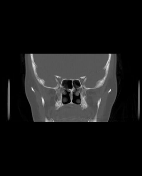 File:Automastoidectomy with labyrinthine fistula (Radiopaedia 84143-99411 Coronal non-contrast 53).jpg