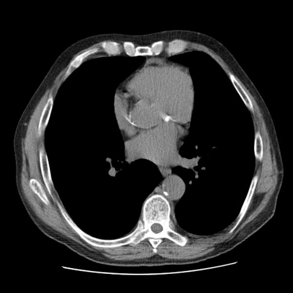 File:Autosomal dominant polycystic kidney disease (Radiopaedia 27851-28094 Axial non-contrast 33).jpg