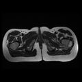 Avascular necrosis of the hip (Radiopaedia 29563-30067 Axial T2 16).jpg
