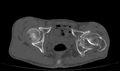 Avascular necrosis of the left hip (Radiopaedia 75068-86125 Axial bone window 56).jpg