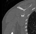 Avulsion fracture - greater tuberosity of humerus (Radiopaedia 71216-81514 Coronal bone window 54).jpg