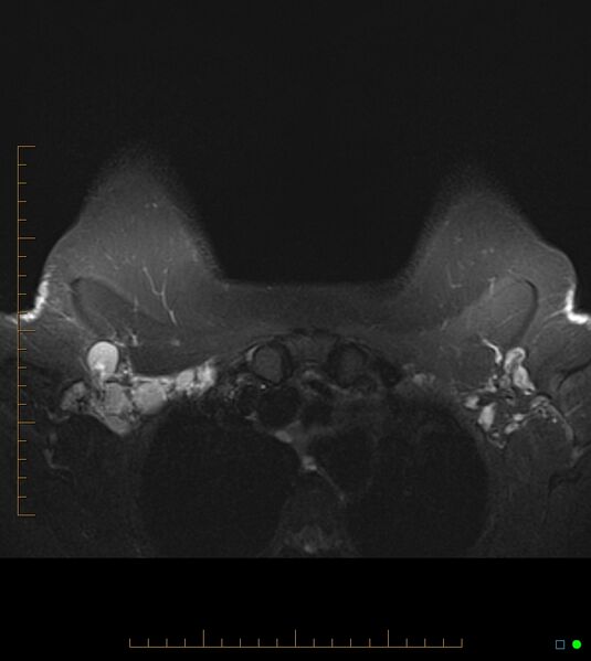 File:Axillary lymphadenopathy on breast MRI- yellow fever vaccination induced (Radiopaedia 19454-19483 Axial T2 fat sat 3).jpg