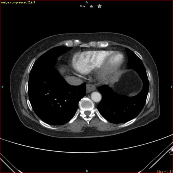 File:Azygos vein aneurysm (Radiopaedia 77824-90130 B 42).jpg