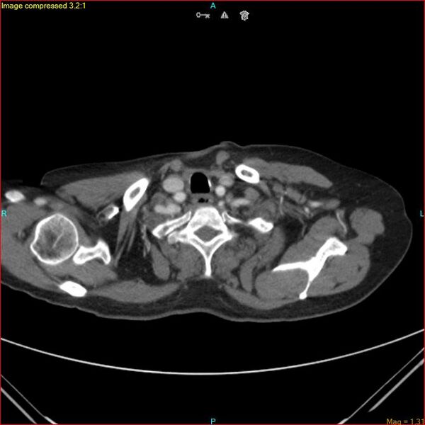 File:Azygos vein aneurysm (Radiopaedia 77824-90130 B 7).jpg