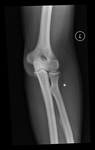 File:BB (ball bearing) bullet within the soft tissues of the forearm (Radiopaedia 44382-48017 Oblique 1).jpg