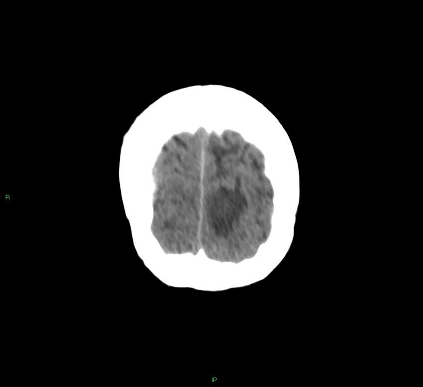 Basal ganglia hemorrhage (Radiopaedia 58766-65988 Coronal non-contrast 10).jpg