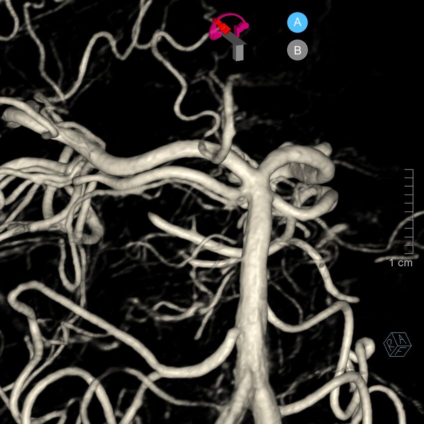 Basilar artery perforator aneurysm (Radiopaedia 82455-97734 3D view left VA 123).jpg