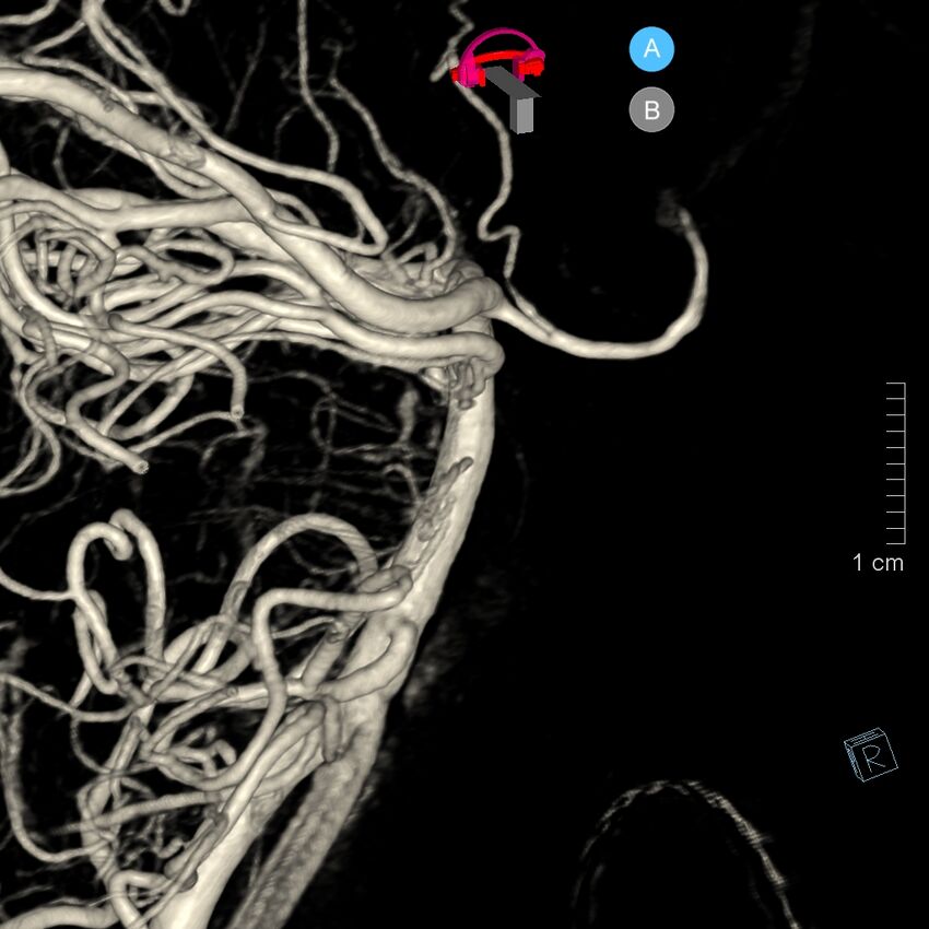 Basilar artery perforator aneurysm (Radiopaedia 82455-97734 3D view left VA 67).jpg