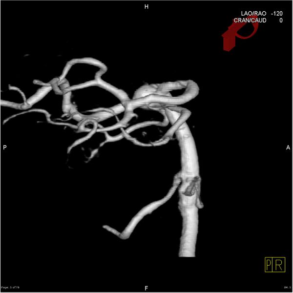 File:Basilar tip aneurysm double balloon remodeling (Radiopaedia 18100-17883 3D rotation 5).jpg