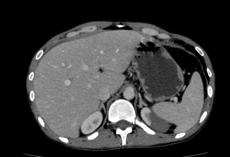 File:Behçet's disease- abdominal vasculitis (Radiopaedia 55955-62570 A 13).jpg