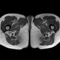 Bicornuate uterus (Radiopaedia 61974-70046 Axial T1 47).jpg