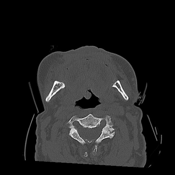 File:Bilateral Le Fort fractures (Radiopaedia 32192-33135 Axial bone window 21).jpg