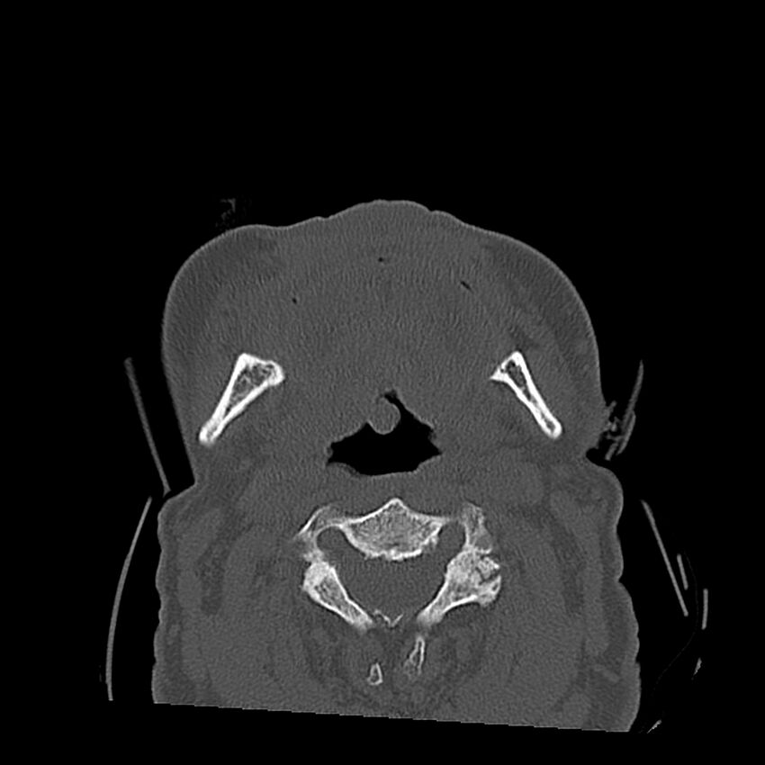 Bilateral Le Fort fractures (Radiopaedia 32192-33135 Axial bone window 21).jpg