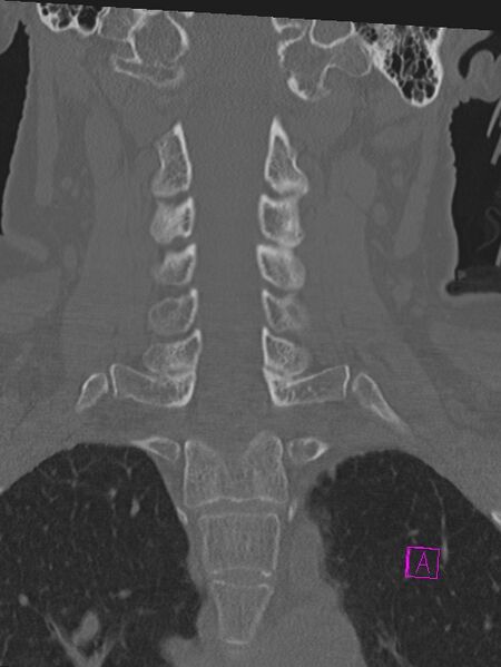 File:Bilateral atlanto-occipital assimilation (Radiopaedia 28350-28603 Coronal bone window 23).jpg