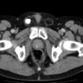 Bilateral direct inguinal herniae (Radiopaedia 17016-16719 B 24).jpg