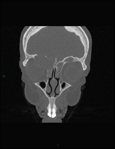 File:Bilateral frontal mucoceles (Radiopaedia 82352-96454 Coronal 95).jpg