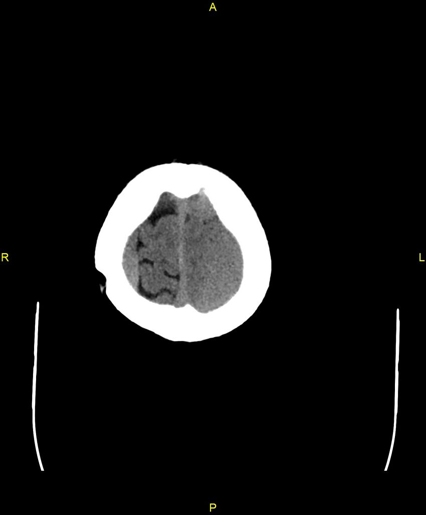Bilateral isodense subdural hematomas (Radiopaedia 88621-105325 Axial non-contrast 101).jpg