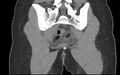Bilateral mature cystic ovarian teratoma (Radiopaedia 88821-105592 Coronal non-contrast 34).jpg