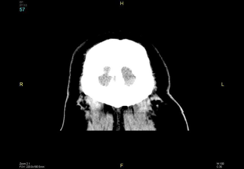 Bilateral medial medullary infarction (Radiopaedia 42220-45295 Coronal non-contrast 57).jpg