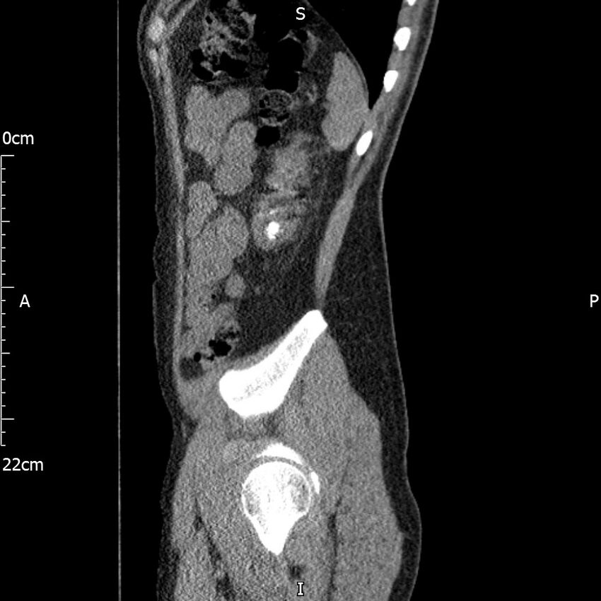 Bilateral medullary nephrocalcinosis with ureteric calculi (Radiopaedia 71269-81569 C 26).jpg