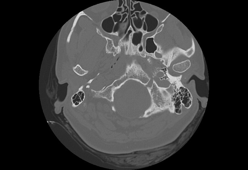 Bilateral otospongiosis (Radiopaedia 35447-36940 B 5).jpg