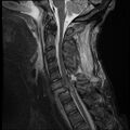 Bilateral perched facets with cord injury (Radiopaedia 45587-49714 Sagittal STIR 7).jpg