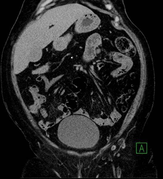 File:Bilateral sporadic synchronous clear cell renal cell carcinoma (Radiopaedia 85035-100575 I 8).jpg