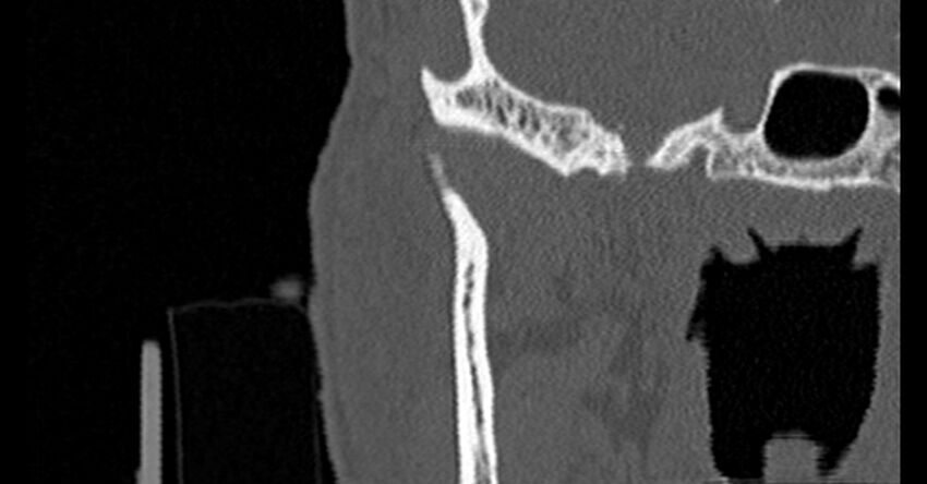 Bilateral temporal bone fractures (Radiopaedia 29482-29970 Coronal non-contrast 24).jpg