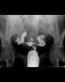 Bilateral tubal block and hydrosalpinx (Radiopaedia 23086-23116 A 4).jpg