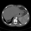 Biliary necrosis - liver transplant (Radiopaedia 21876-21846 A 11).jpg