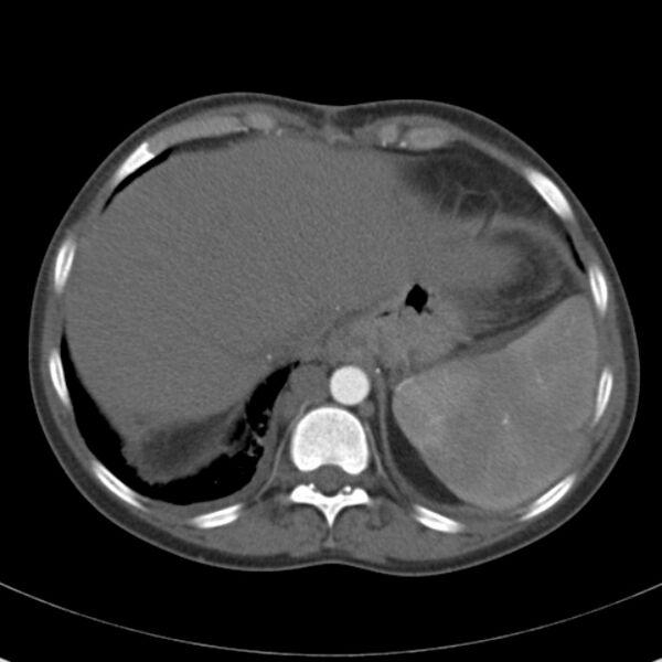 File:Biliary necrosis - liver transplant (Radiopaedia 21876-21846 A 11).jpg