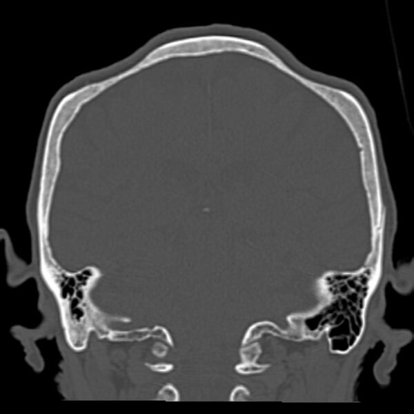 File:Biparietal osteodystrophy (Radiopaedia 46109-50463 Coronal bone window 69).jpg