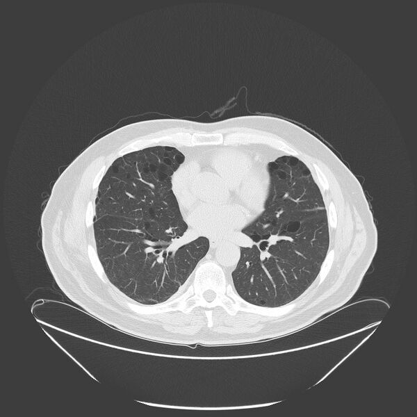 File:Birt-Hogg-Dubé syndrome (Radiopaedia 52578-58491 Axial lung window 36).jpg