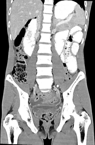 File:Blunt injury to the small bowel (Radiopaedia 74953-85987 B 58).jpg