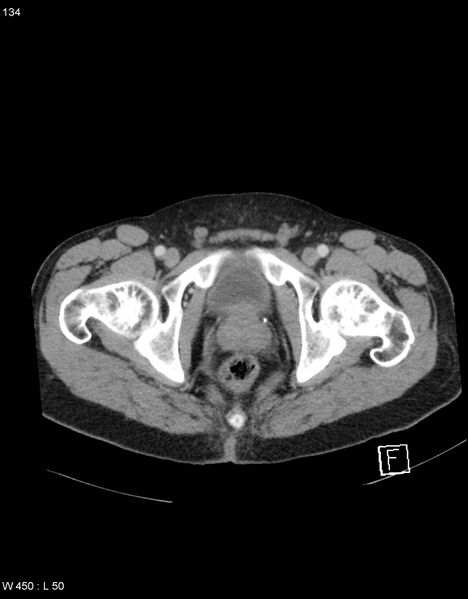 File:Boerhaave syndrome with tension pneumothorax (Radiopaedia 56794-63603 A 67).jpg