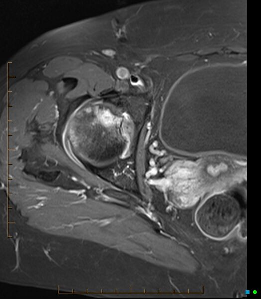 File:Bone metastasis - breast cancer (Radiopaedia 16667-16374 Axial T1 C+ fat sat 13).jpg