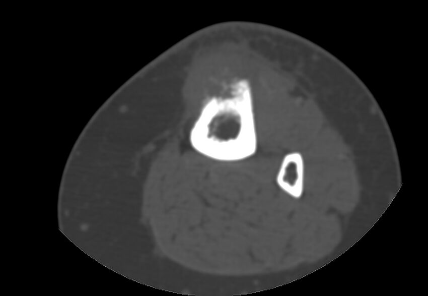 Bone metastasis - tibia (Radiopaedia 57665-64609 Axial bone window 55).jpg