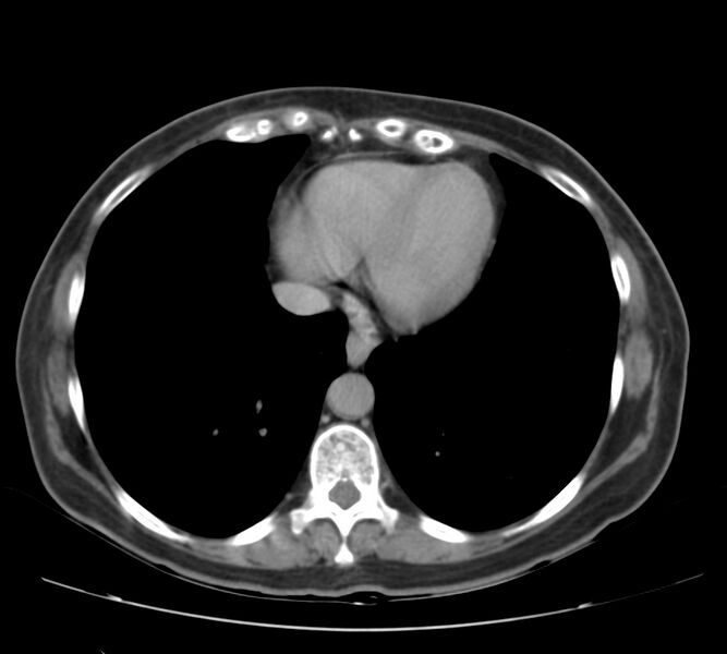File:Bosniak renal cyst - type IV (Radiopaedia 22929-22953 D 1).jpg