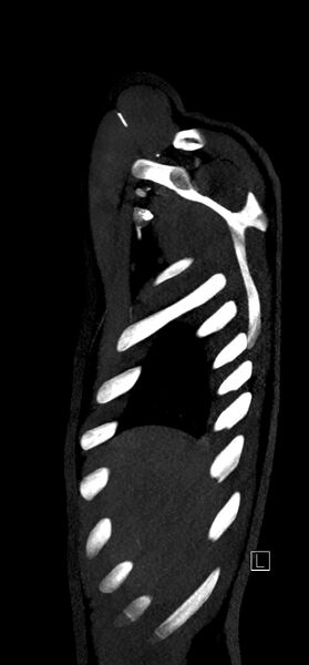 File:Brachiocephalic trunk pseudoaneurysm (Radiopaedia 70978-81191 C 10).jpg