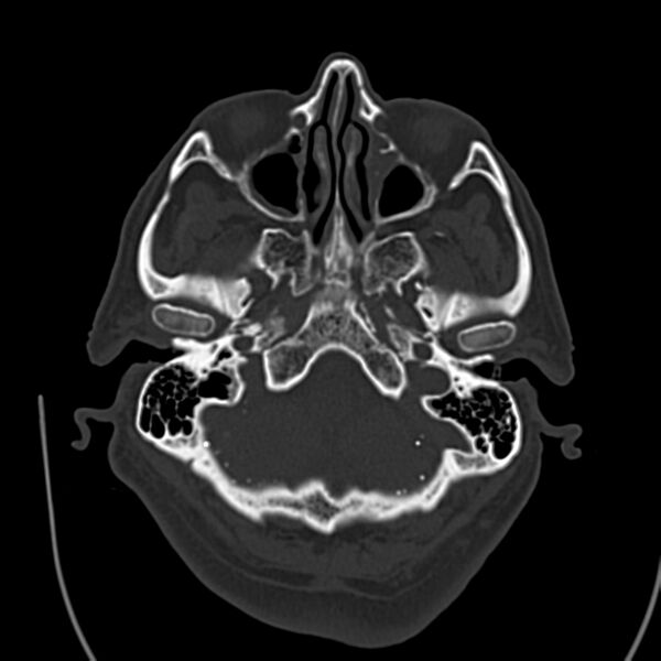 File:Brain Pantopaque remnants (Radiopaedia 78403-91048 Axial bone window 18).jpg
