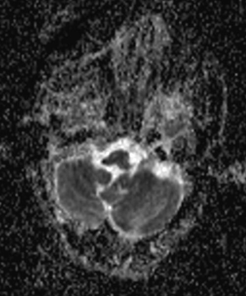 File:Brain abscess with dual rim sign (Radiopaedia 87566-103938 Axial ADC 2).jpg