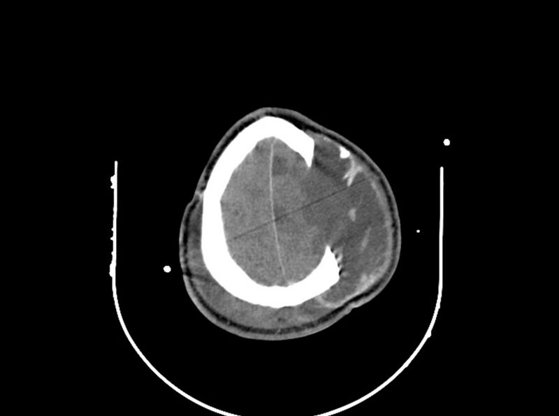 File:Brain injury by firearm projectile (Radiopaedia 82068-96087 B 159).jpg