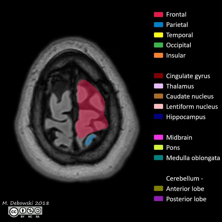 Brain lobes - annotated MRI (Radiopaedia 61691-69700 Axial 3).JPG
