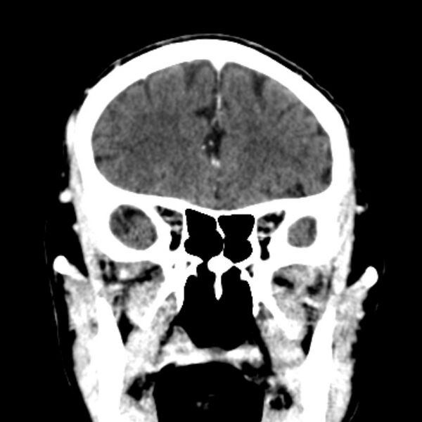 File:Brain metastases from lung cancer (Radiopaedia 27849-28092 Coronal C+ delayed 19).jpg