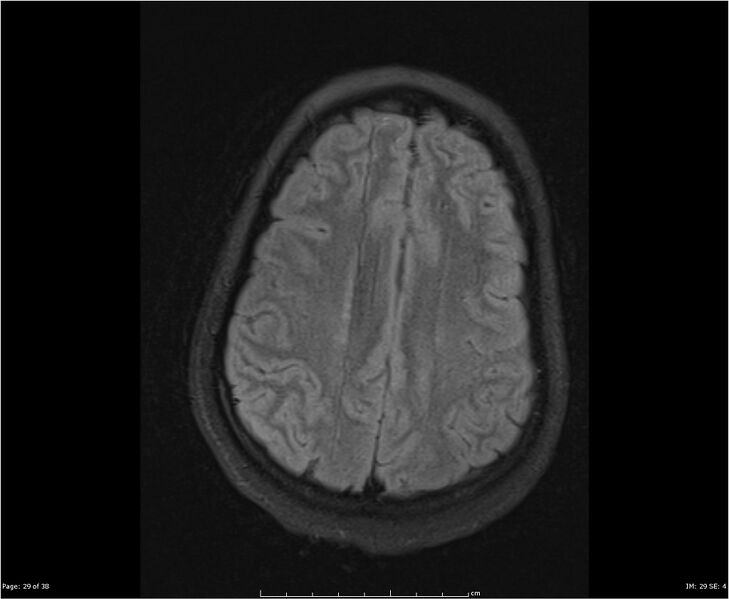 File:Brainstem glioma (Radiopaedia 21819-21775 Axial FLAIR 29).jpg