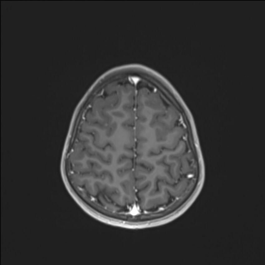 Brainstem glioma (Radiopaedia 70548-80674 Axial T1 C+ 127).jpg